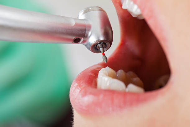Best Emergency Dental Care for Abscessed Tooth in Toro Nyon, CA
